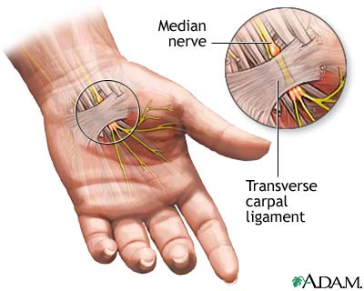 Carpal Tunnel Syndrome treatment