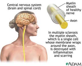 Cause of Multiple Sclerosis