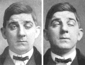 Symptoms of Myasthenia Gravis 