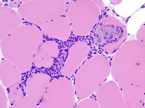 myositis-polymyositis-dermatomyositis